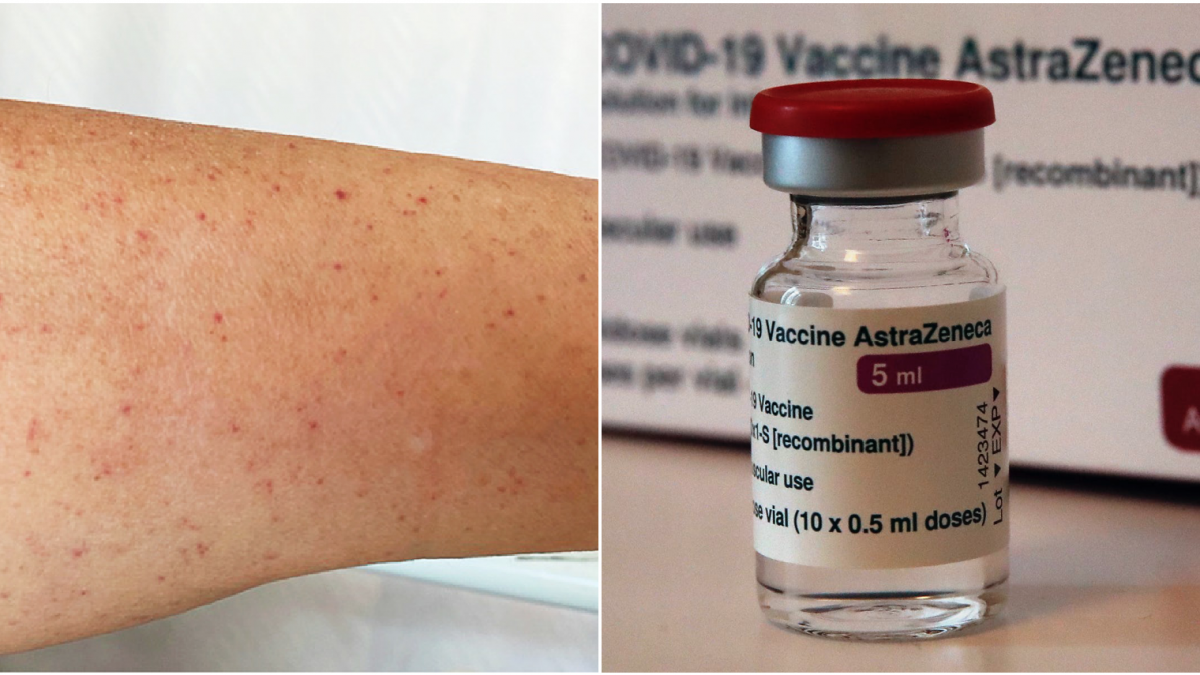 A study of 5.4 million people has linked AstraZeneca’s Covid vaccine to another bleeding disorder that can cause a rash