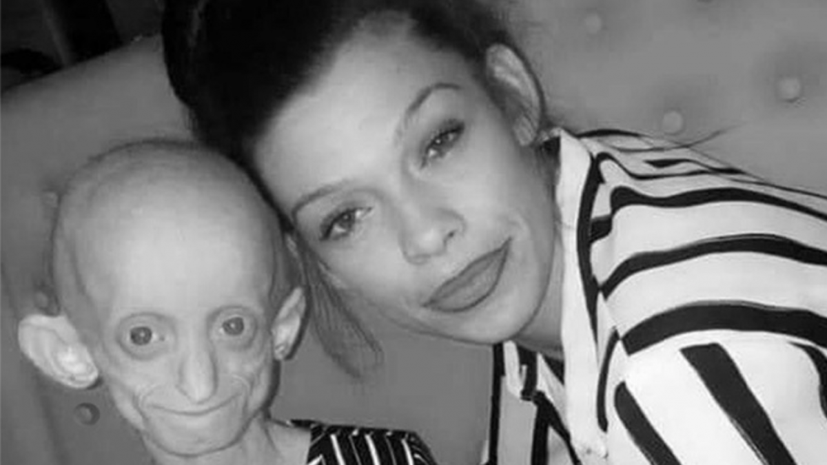 18-year-old with Benjamin Button disease that aged her body to 144 has died: “Mom, you have to let me go”