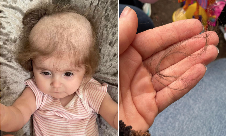 Mother of a baby girl, who was born with a rare genetic illness which is causing to tear her own hair out, says she is shaving her daughter’s head to raise money for another toddler’s cancer treatment